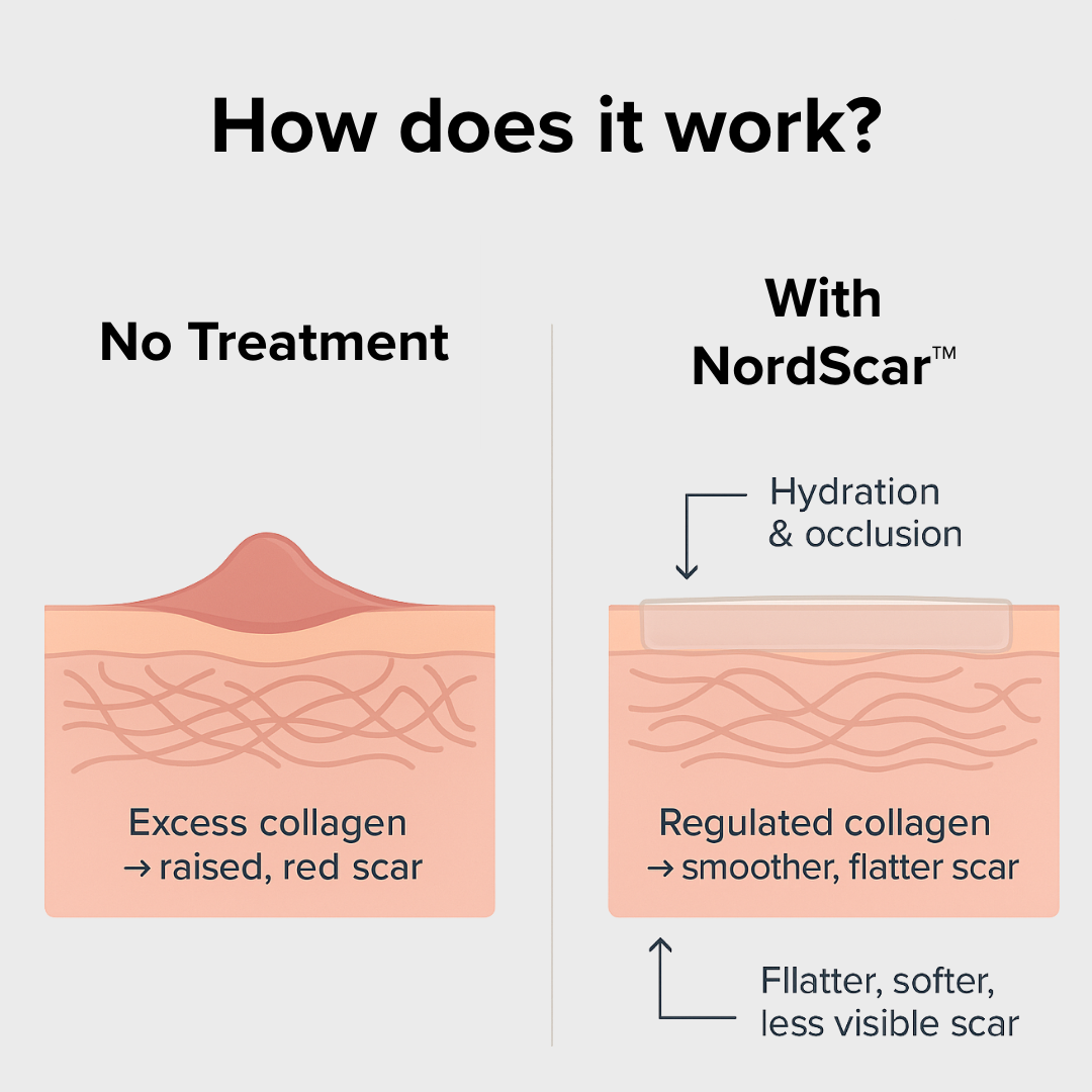 NordScar™ Silicone Scar Sheets