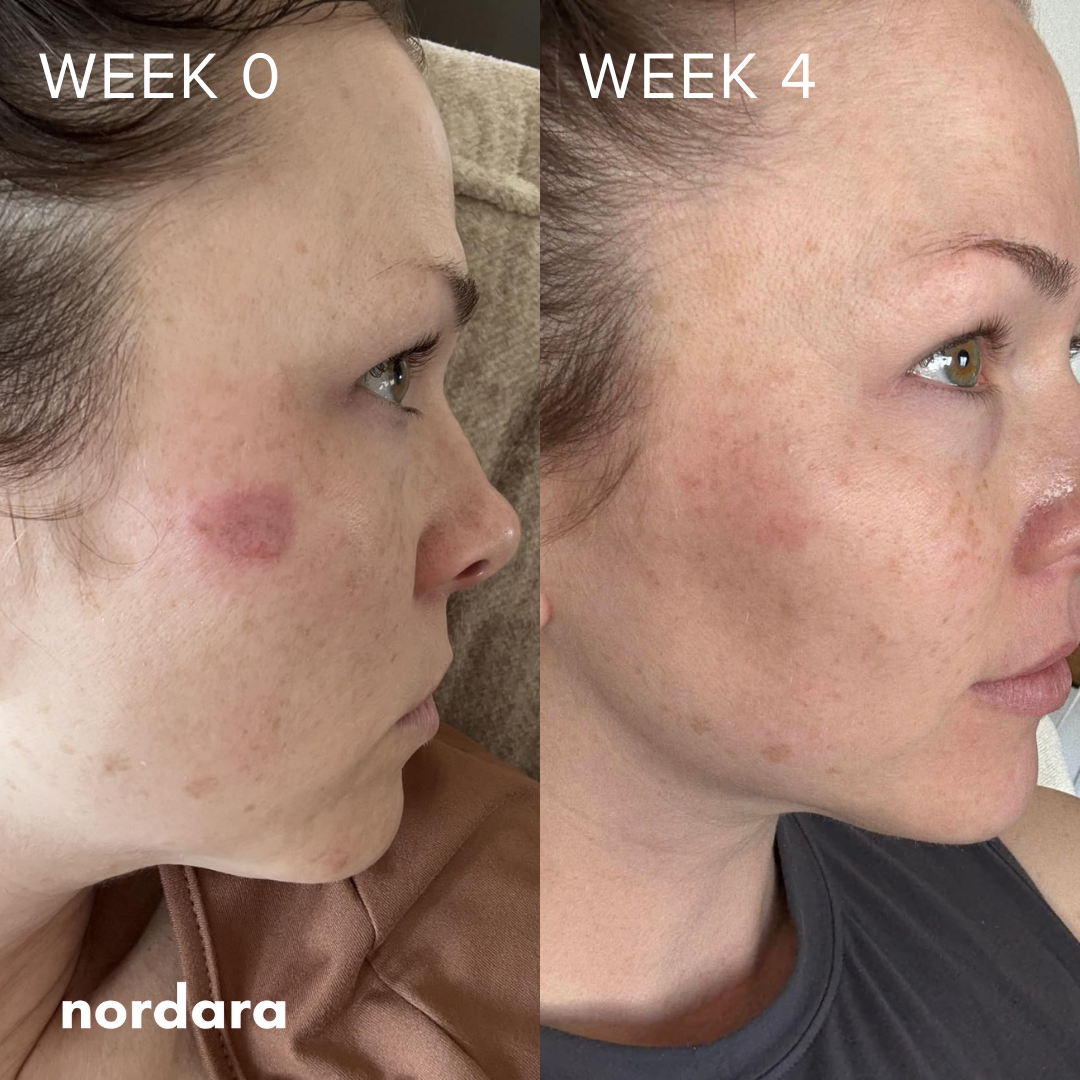 NordScar™ Silicone Scar Sheets