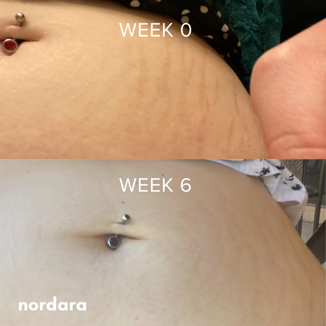 NordScar™ Silicone Scar Sheets