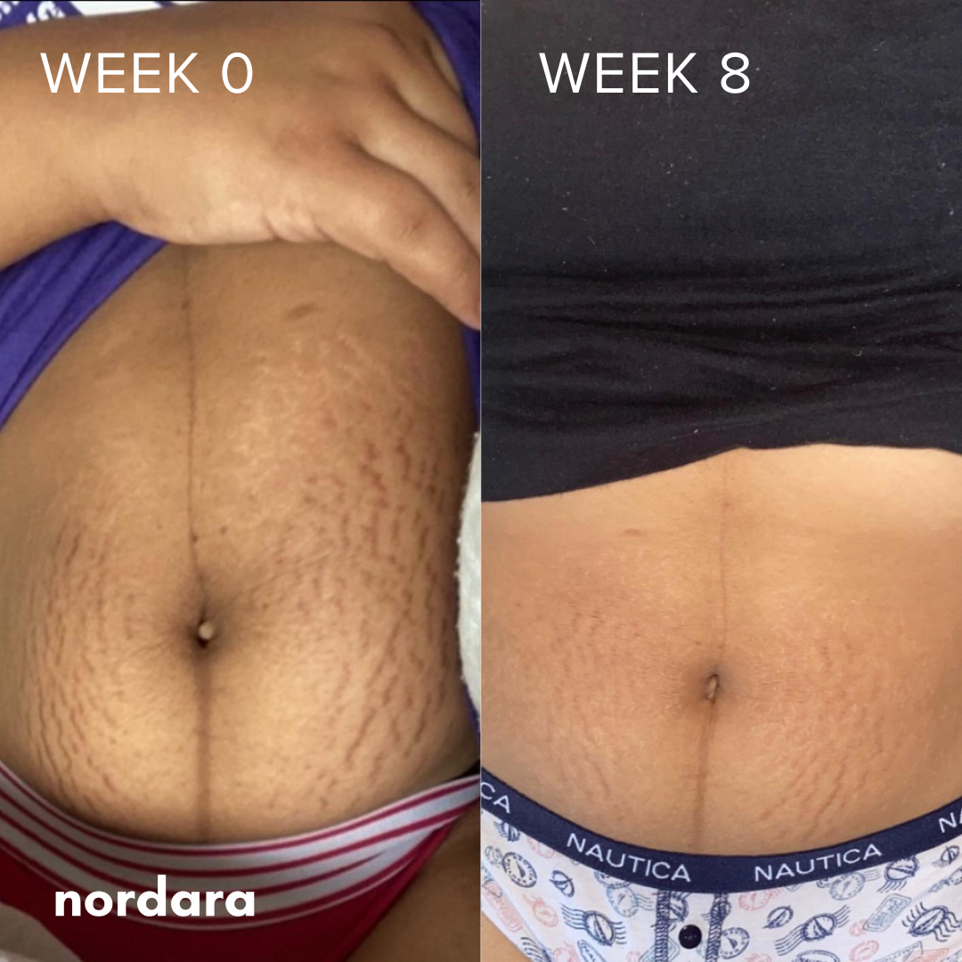 NordScar™ Silicone Scar Sheets